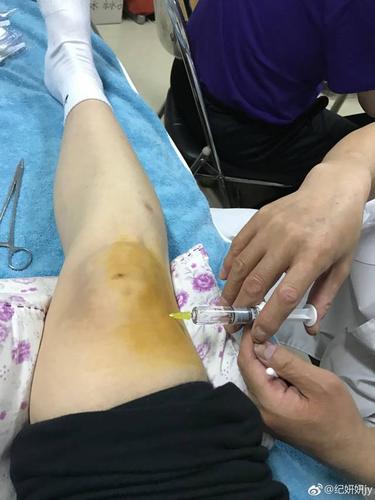 跟队记者谈马特塔膝盖问题：比赛可打针坚持根治需手术