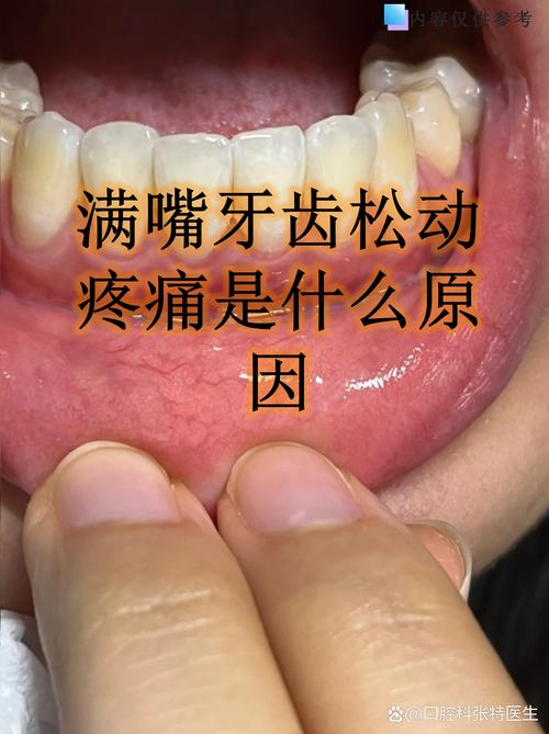 奇克多颗牙齿因牙槽骨骨折脱落，康复期面临挑战