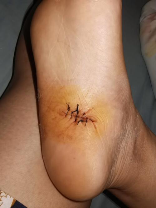 克尔斯托维奇发伤口照：补时造点后承诺很快归来